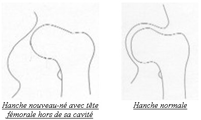 comment avoir des hanches